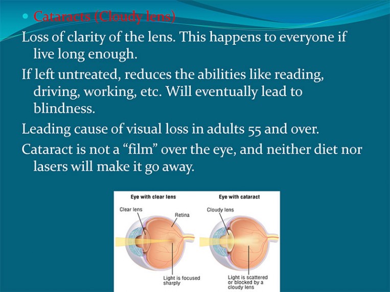 Cataract Explanation 1