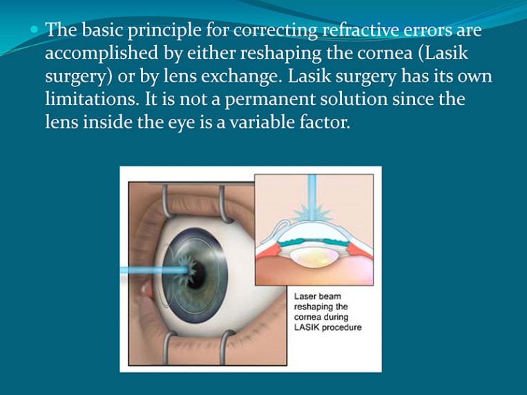 Cataract Explanation 4