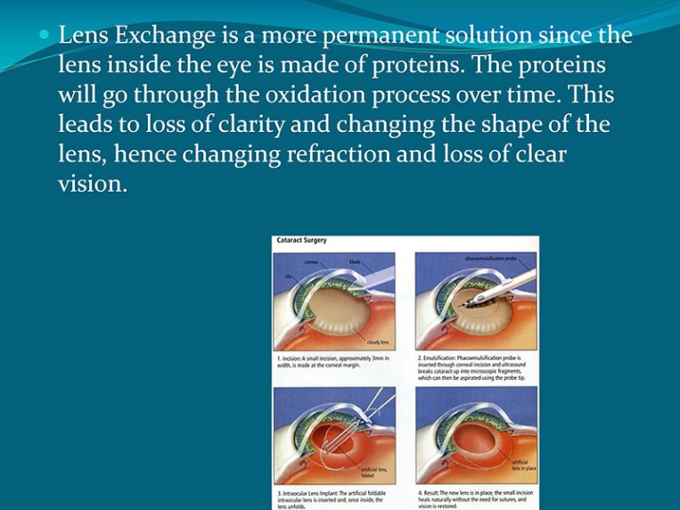 Cataract Explanation 5